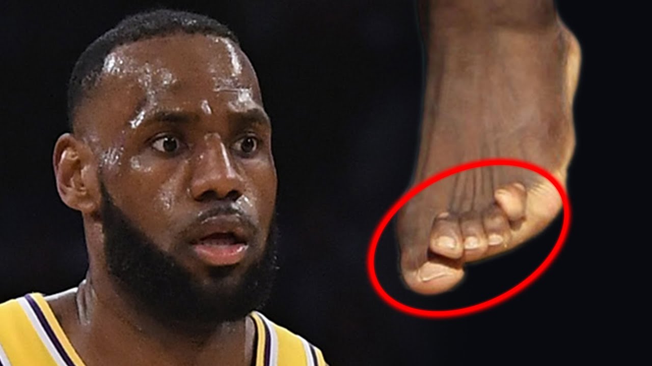 LeBron James' Foot Condition гҽvҽαled: The Untold Story of King NBA Perseverance and Determination